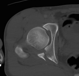 Acetabulum Posterior Wall Fracture
